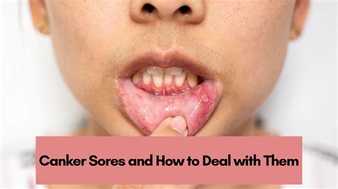 canker sores