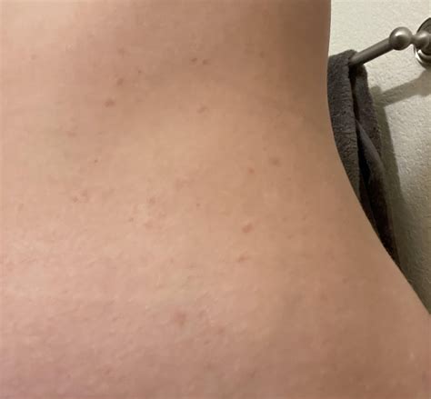 Diagnosed with pityriasis rosea by one dermatologist and other says it