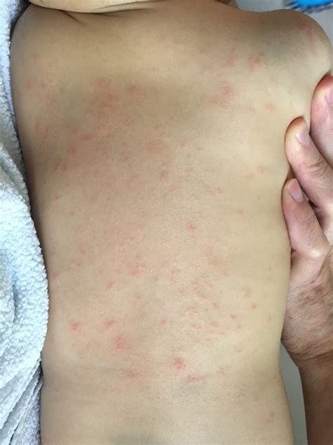 Dust Mites On Skin
