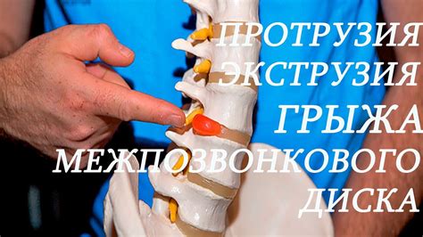 Ключевые термины на курсах костоправства!Что такое протрузия,экструзия ...
