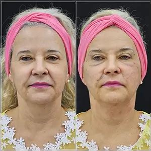 Endolaser Antes E Depois - Lifting Facial com Endolaser