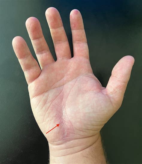 It’s just carpal tunnel, right? — Jeffrey Hatef, M.D. - Columbus