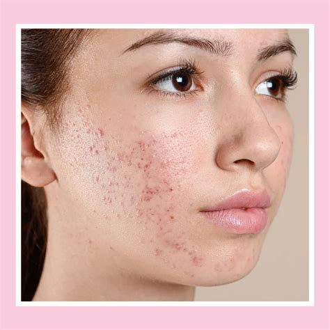 Acne Treatment London | Clear Skin Solutions