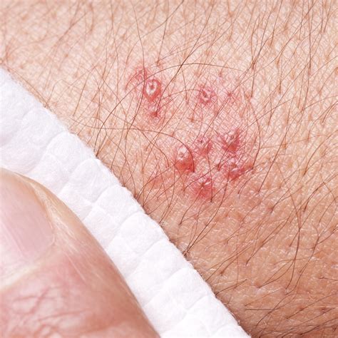Shingles Symptoms On Legs