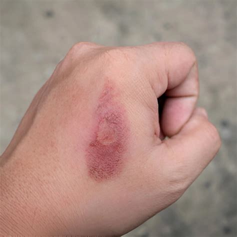 burns everlastwellness