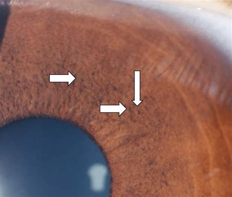 Left eye Lisch nodules in case 2 | Download Scientific Diagram