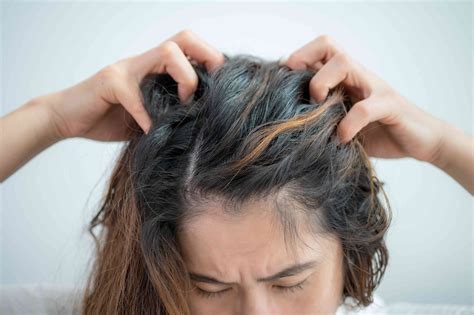 Itching For Answers: Distinguishing Between Lice And Dandruff