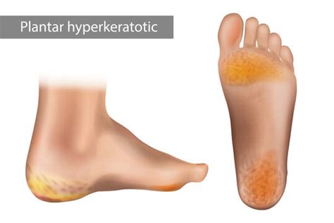 Hyperkeratosis