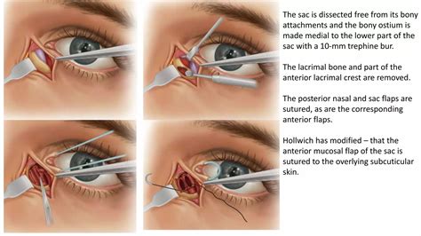 Naso orbito ethmoid (noe) complex fracture | PPTX