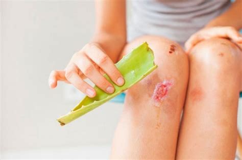 Sábila para cicatrización rápida y efectiva: secretos revelados | Aloe