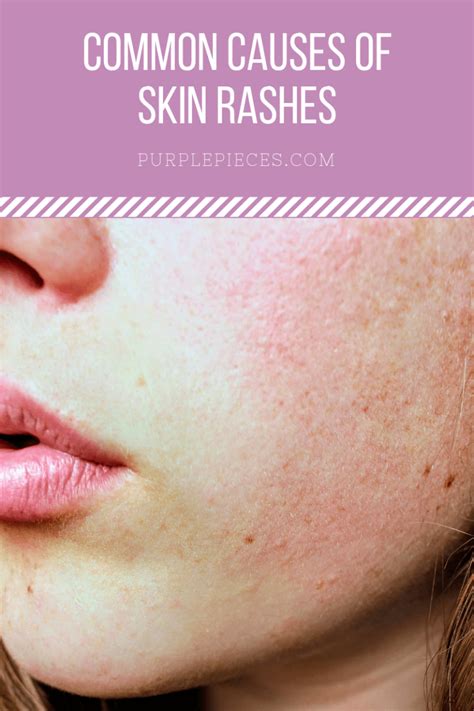 Common Causes of Skin Rashes
