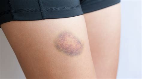 O Que Pode Ser Mancha Roxa No Corpo - Hematoma no corpo: como tratar manchas roxas com simplicidade – Fledoid
