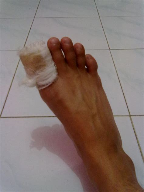 cara menghilangkan bengkak di kaki karena jatuh 4