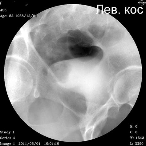 Урография Нисходящая цистография | Портал радиологов