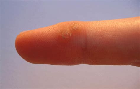 How to Remove Warts at Home: Painless, Easy and Cheap Remedies | Healdove