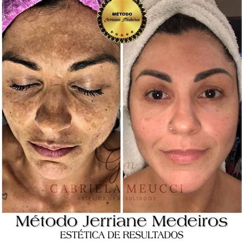 Ácido Tranexâmico Melasma Antes E Depois - ácido Tranexâmico Injetável Para Melasma Antes E Depois - RETOEDU