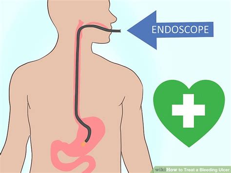 How to Treat a Bleeding Ulcer: 14 Steps (with Pictures) - wikiHow