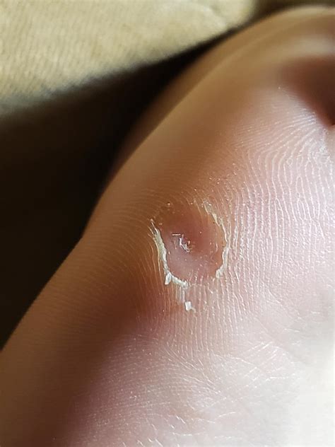 Successful freeze : r/Warts