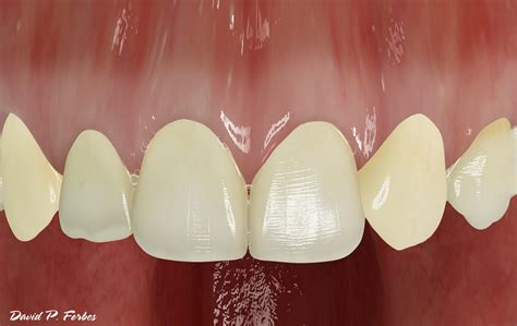 Missing Teeth - Forbes Orthodontics