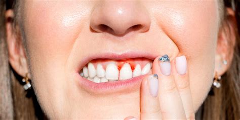 Gingivitis - Prevalence, Symptoms, Treatment