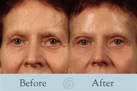 Facelift Before and After - Pittman Plastic Surgery - Athens Georgia
