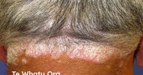 Scalp psoriasis image