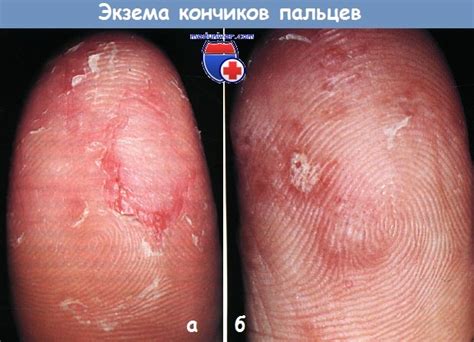 Экзема кончиков пальцев