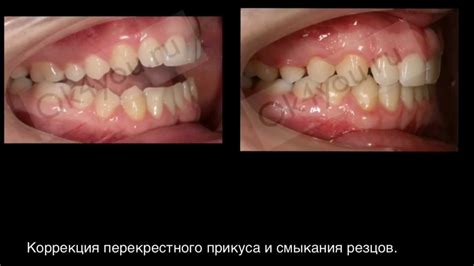 Открытый прикус и ортогнатическая хирургия. - YouTube