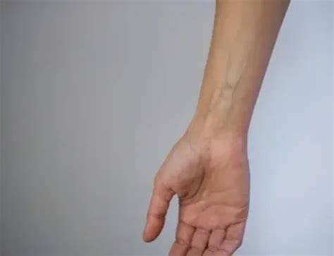 What Causes Green Veins - Vein Institute Of Pinellas