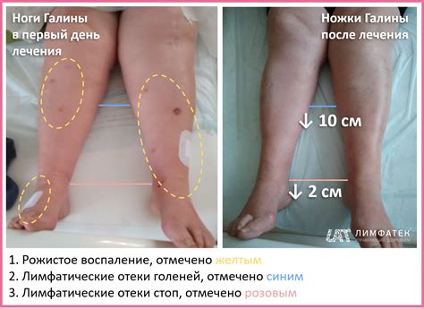 Отеки Ног Фото — Bluemorphotours.ru