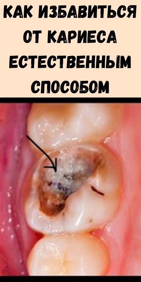 Как избавиться от кариеса естественным способом - Упражнения и похудение