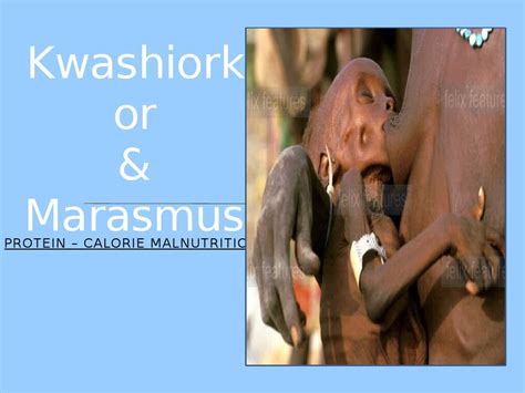 PPP - Kwashiorkor & Marasmus | Malnutrition | Diseases And Disorders