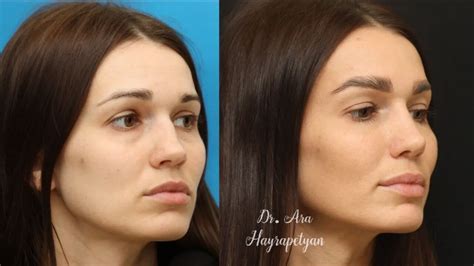Ринопластика в Ереване, цены на пластику носа | Dr. Ara Hayrapetyan