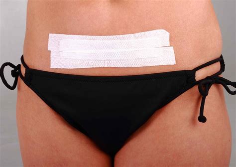 Best Scar Treatment After C Section at Janis Clayson blog