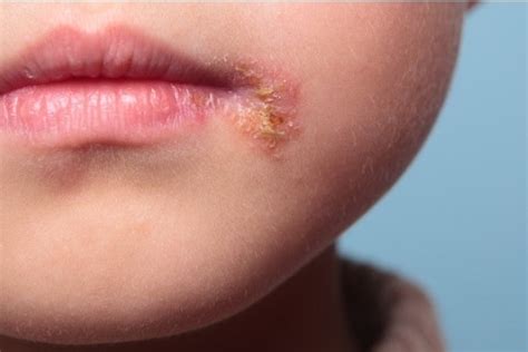 Epidermolysis bullosa sy kanseran'ny hoditra: aretina sy fitsaboana