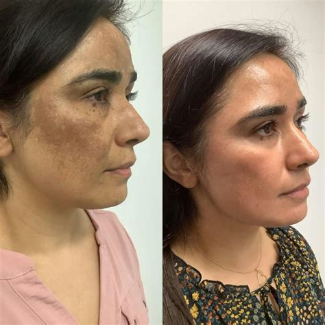 personalized treatment plan  de pigmentation  chandigarh