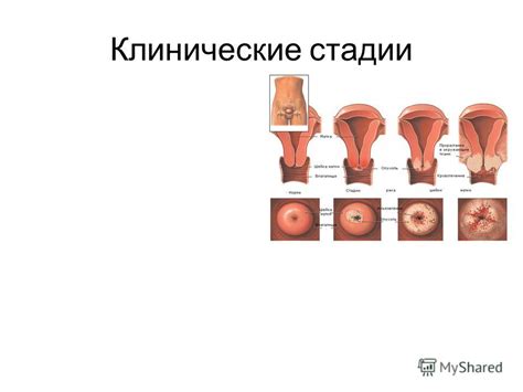 Презентация на тему: "РАК ШЕЙКИ МАТКИ. Рак шейки матки – это ...