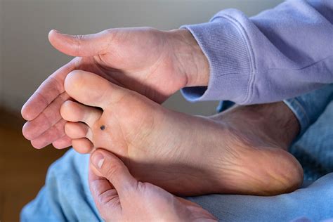 prevent fix  verruca waverley clinic farnham