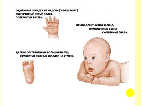 Синдром Дауна - презентация онлайн