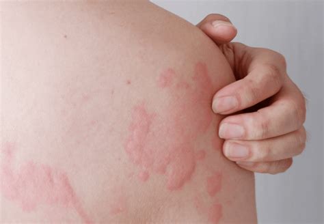 hives rash urticaria diagnosis treatment  singapore lumine