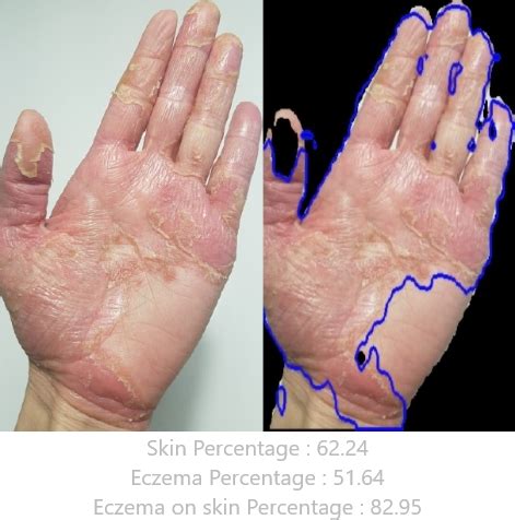 eczemaless skin surface