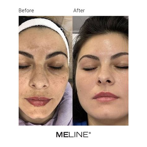 ME LINE® θεραπεία δυσχρωμιών - Κέντρο Αισθητικής Beauty & Life