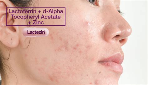 The Dos and Don'ts Of Inflammatory Acne Treatment - Lactezin