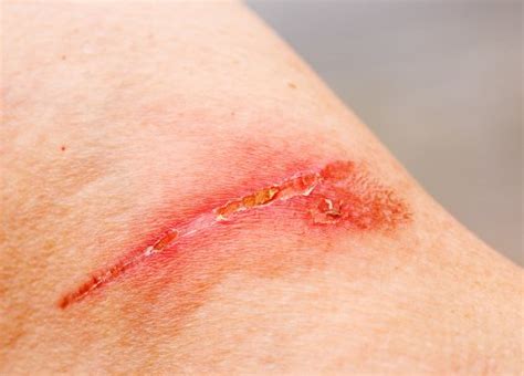 Basic Wound Closure Techniques - Step To Health