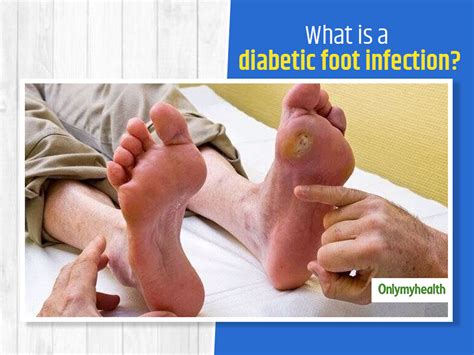 Type 2 Diabetes With Foot Infection Icd 10 at Hunter Wang blog