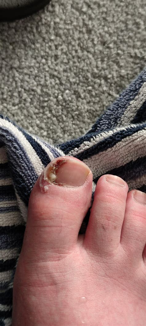I had an ingrown toenail and the podiatrist removed part of the nail