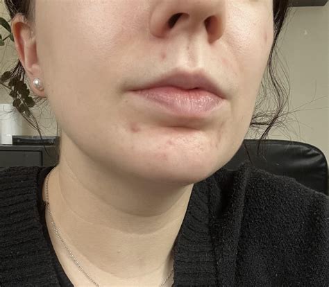[Acne] Advice on post acne marks : r/SkincareAddiction