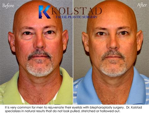 Lower Eye Bag Surgery | Dr. Kolstad - San Diego Facial Plastic Surgeon