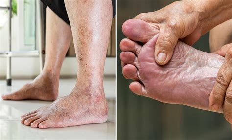 What is Stage 3 of PAD? - Vascular Health