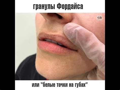 Гранулы Фордайса на губах - YouTube